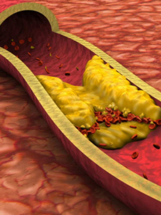 5 Vitamins That Keep Arteries Clean and Unclogged